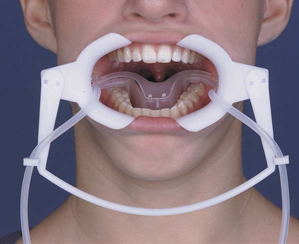 Orthodontic NOLA Retractor, Dry Field Systems